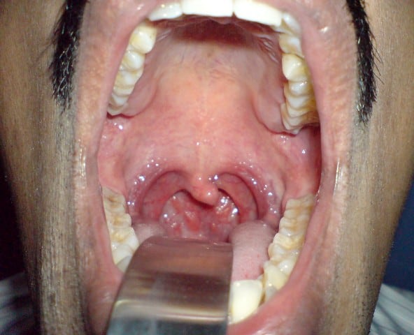 herpes simplex infections - medicinenet.com